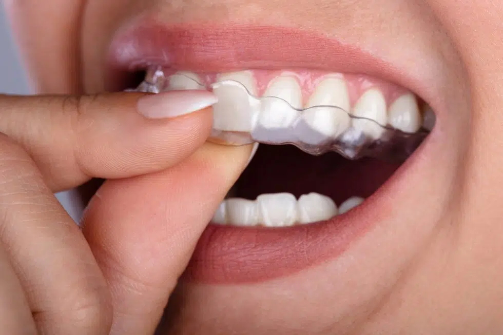 Bergenfield Invisalign treatment at Tenafly Dental Spa - Straighten your smile discreetly with Invisalign clear aligners.